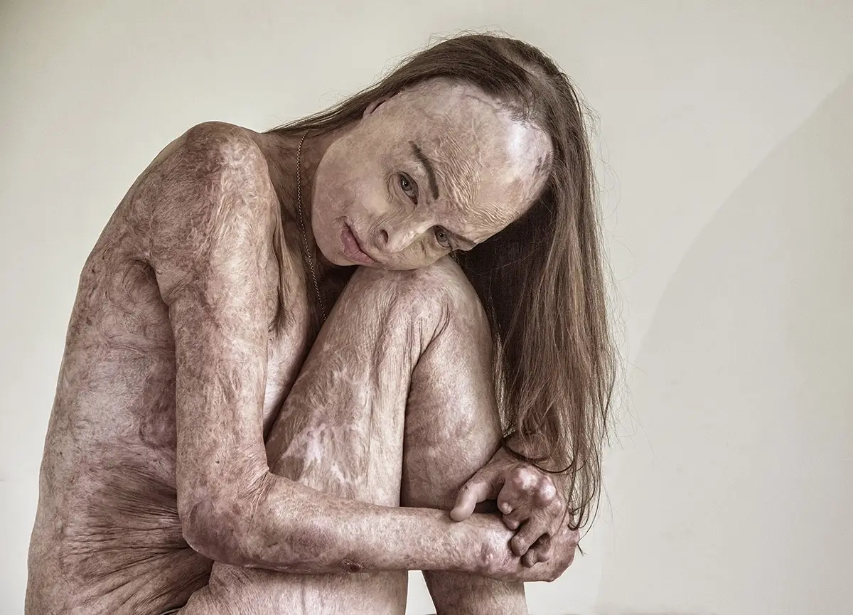The Skin I’m In -  Burns Survivor Carol Mayer<p>© Brian Cassey</p>